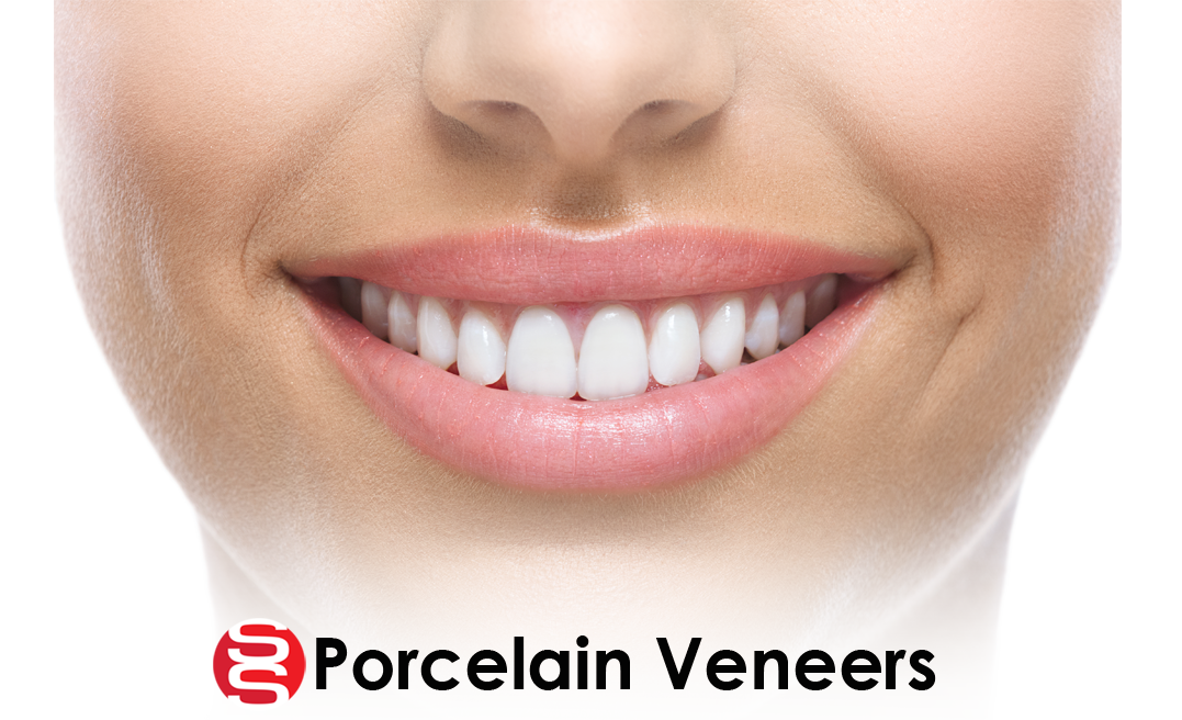 veneers-banner