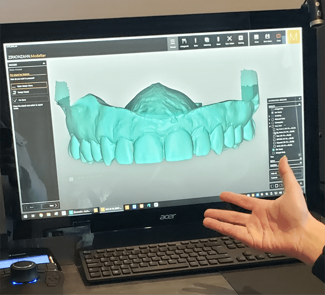 Veneers Tech Gallery 3